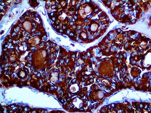 IHC of Thyroglobulin on an FFPE Thyroid Tissue